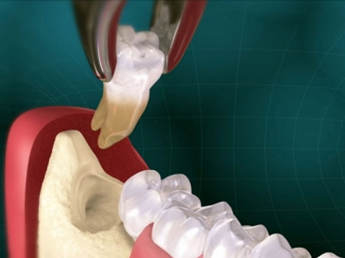 Wisdom Tooth Disimpaction Surgery